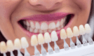 Все про клінічне відбілювання зубів
